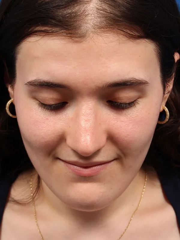 Female Cosmetic Rhinoplasty