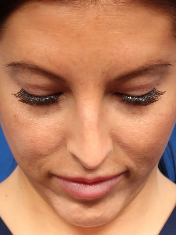 Female Cosmetic Rhinoplasty