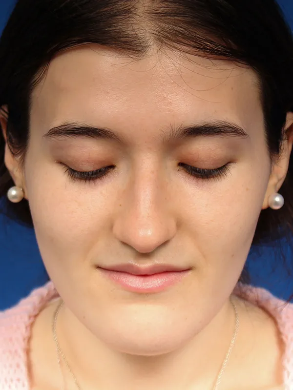 Female Cosmetic Rhinoplasty