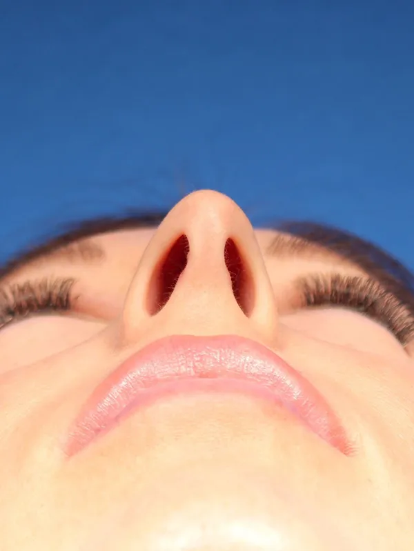 Female Cosmetic Rhinoplasty