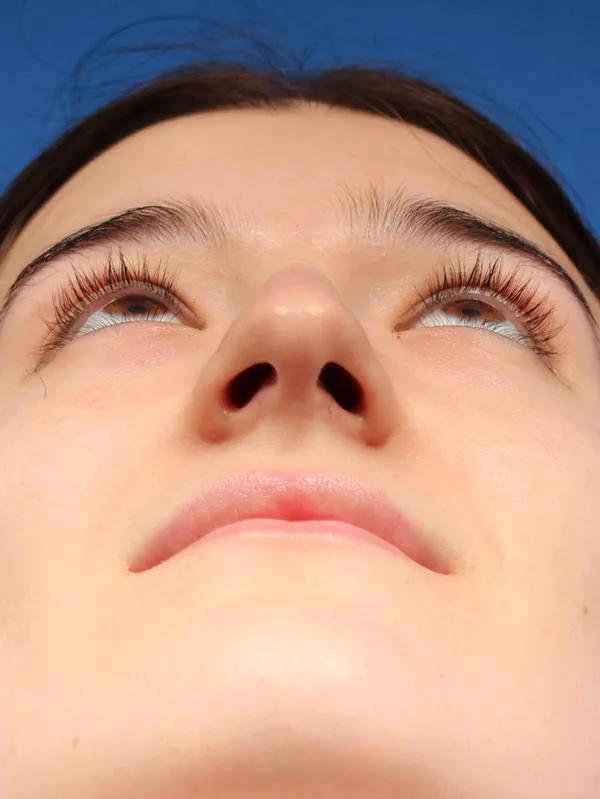 Female Cosmetic Rhinoplasty
