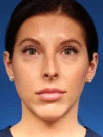 Female Cosmetic Rhinoplasty