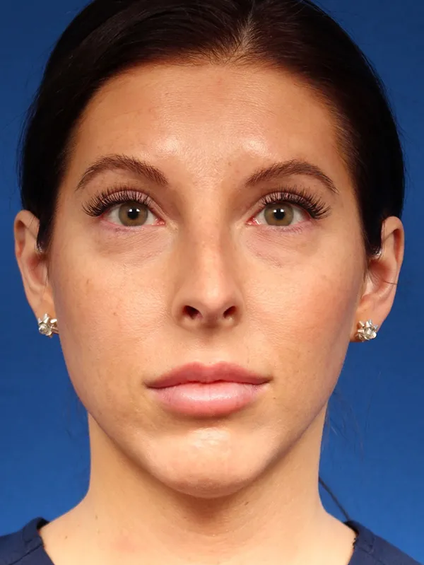 Female Cosmetic Rhinoplasty