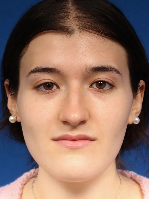 Female Cosmetic Rhinoplasty