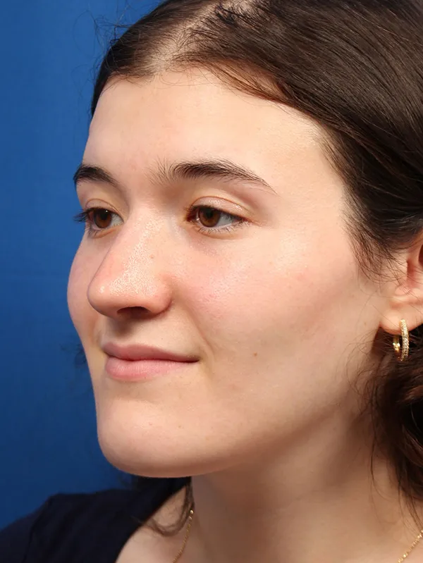 Female Cosmetic Rhinoplasty