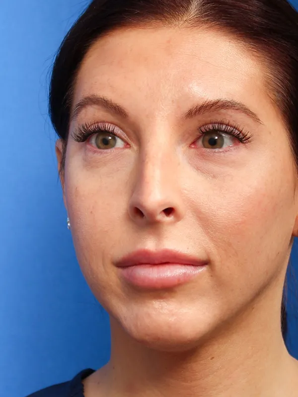 Female Cosmetic Rhinoplasty