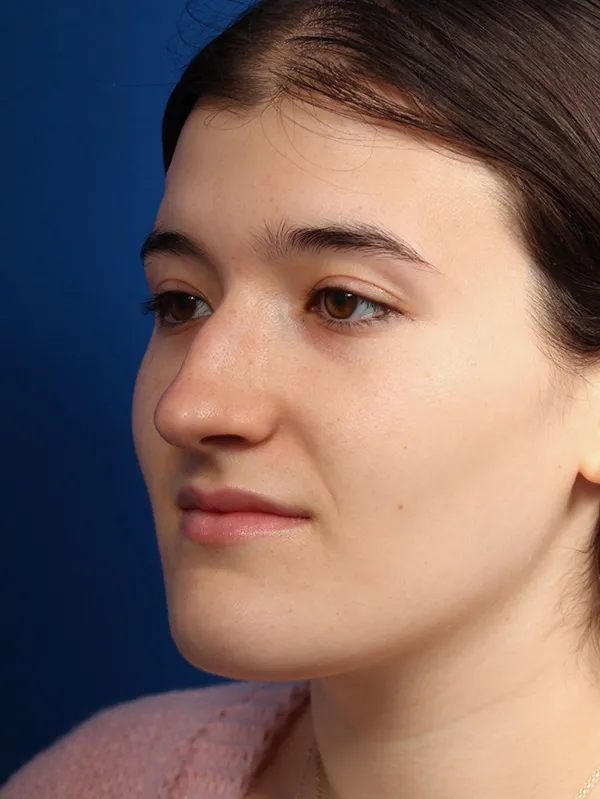 Female Cosmetic Rhinoplasty