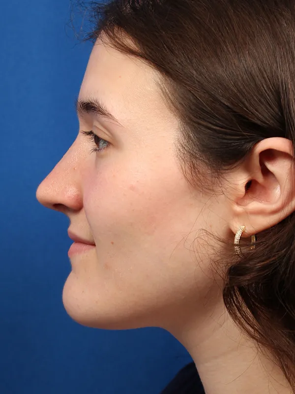 Female Cosmetic Rhinoplasty