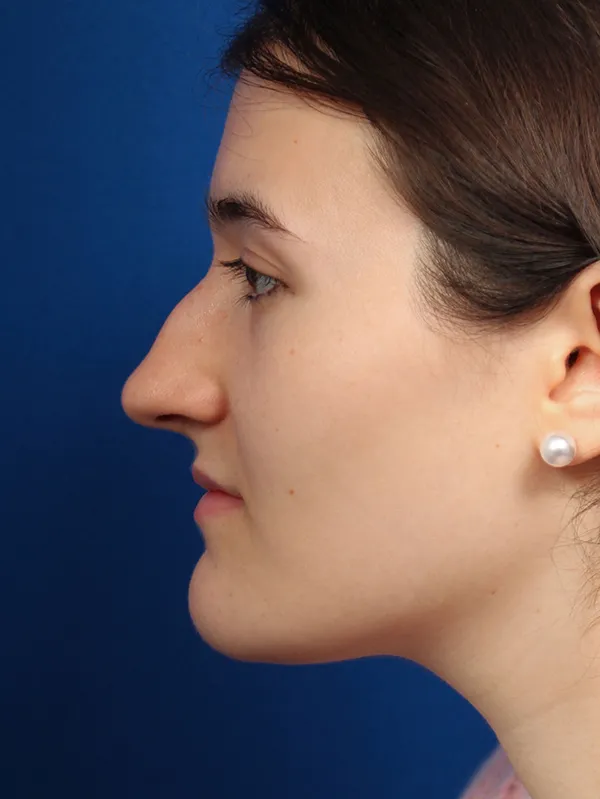Female Cosmetic Rhinoplasty