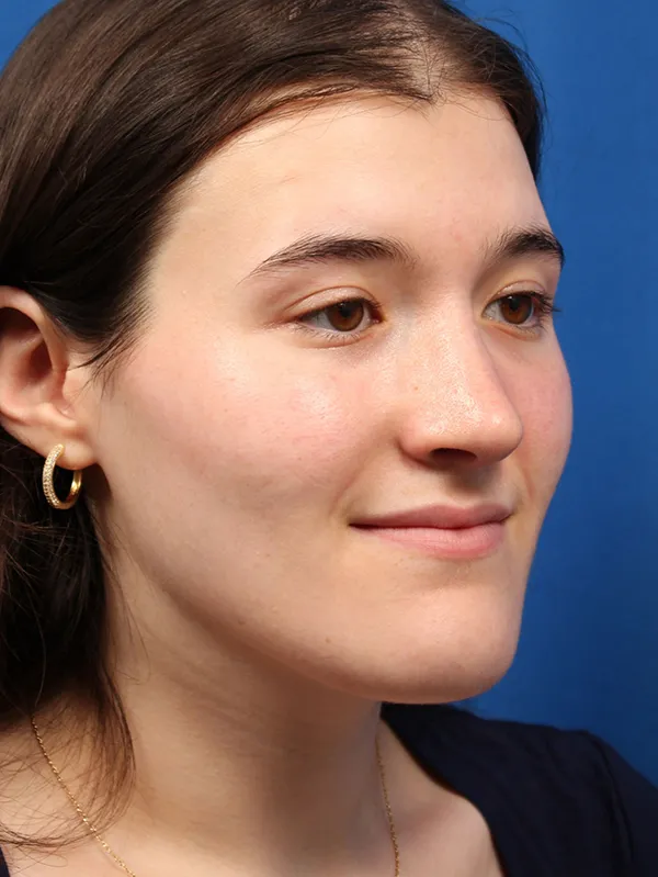 Female Cosmetic Rhinoplasty