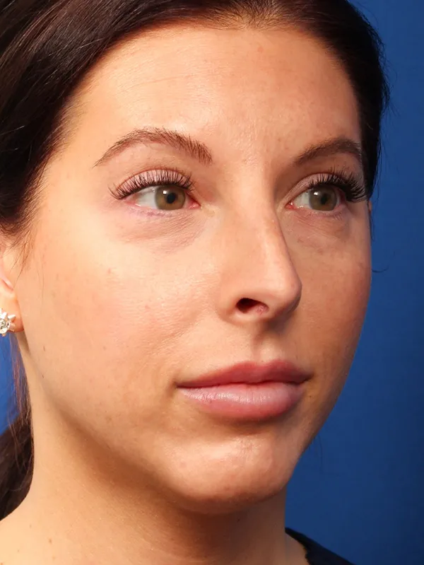 Female Cosmetic Rhinoplasty