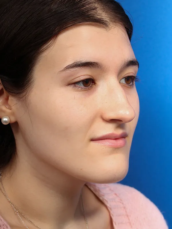 Female Cosmetic Rhinoplasty
