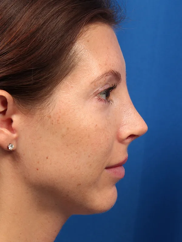 Female Cosmetic Rhinoplasty