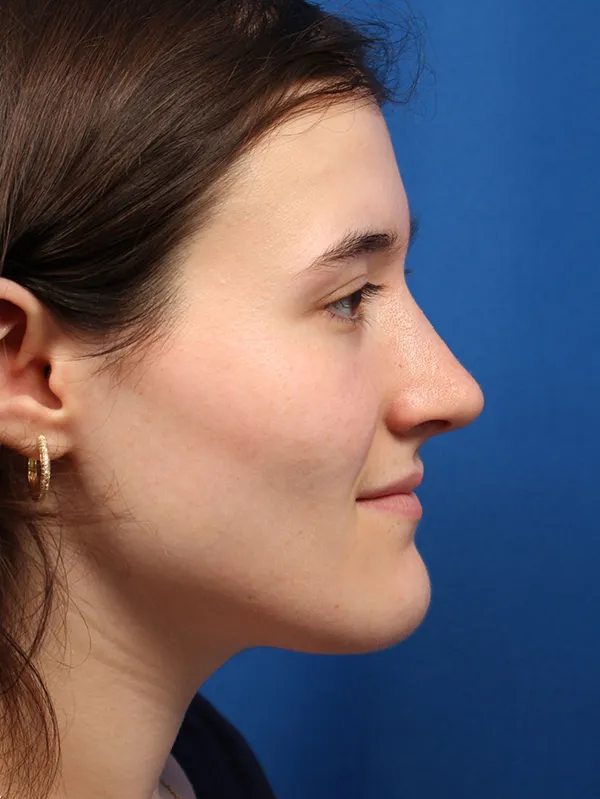 Female Cosmetic Rhinoplasty