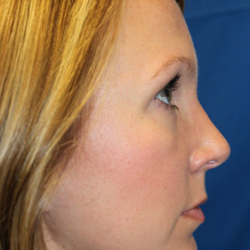 Nose job for men - Rhinoplasty in Michigan