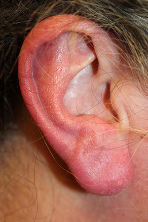 earlobe reduction