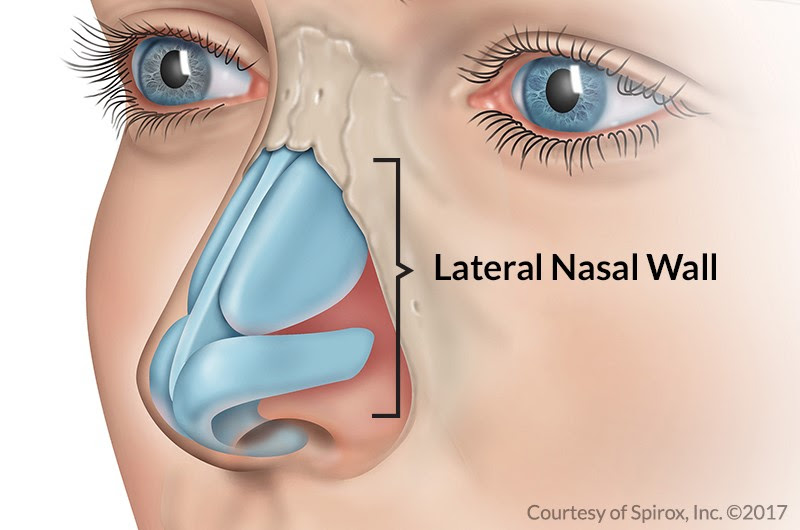 deviated septum