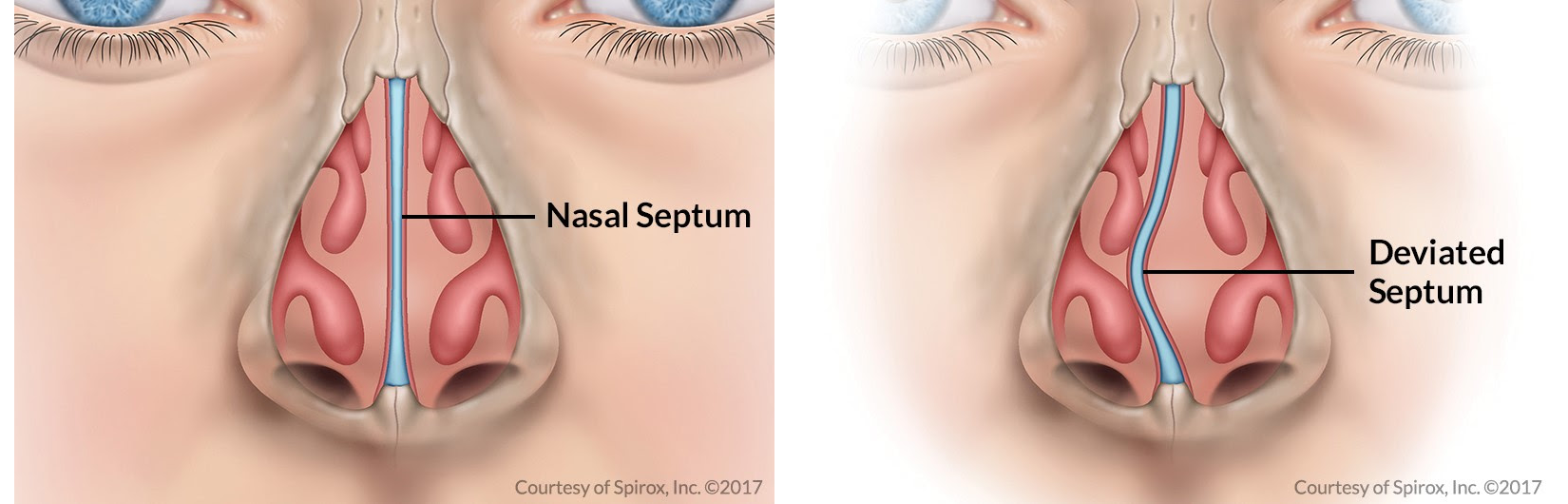 deviated septum