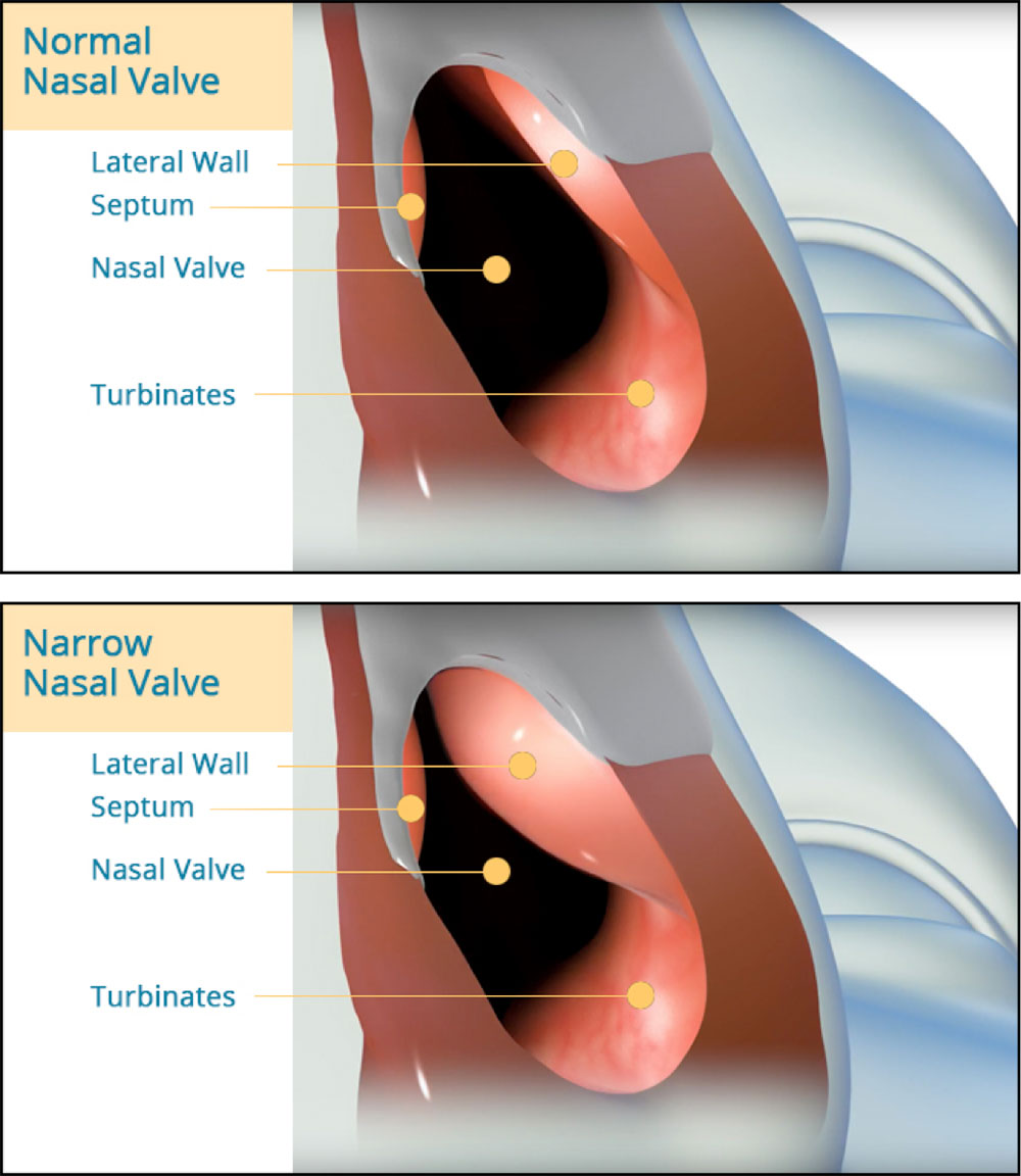Nasal Valve