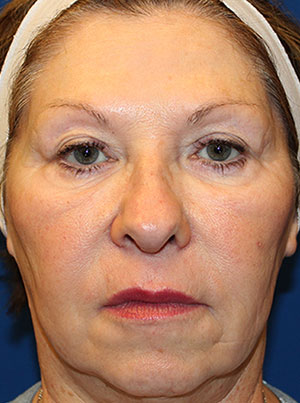 face implant