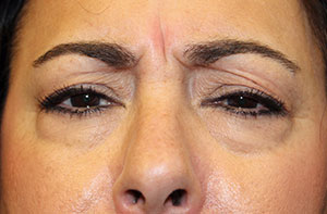 wrinkle reduction with botox