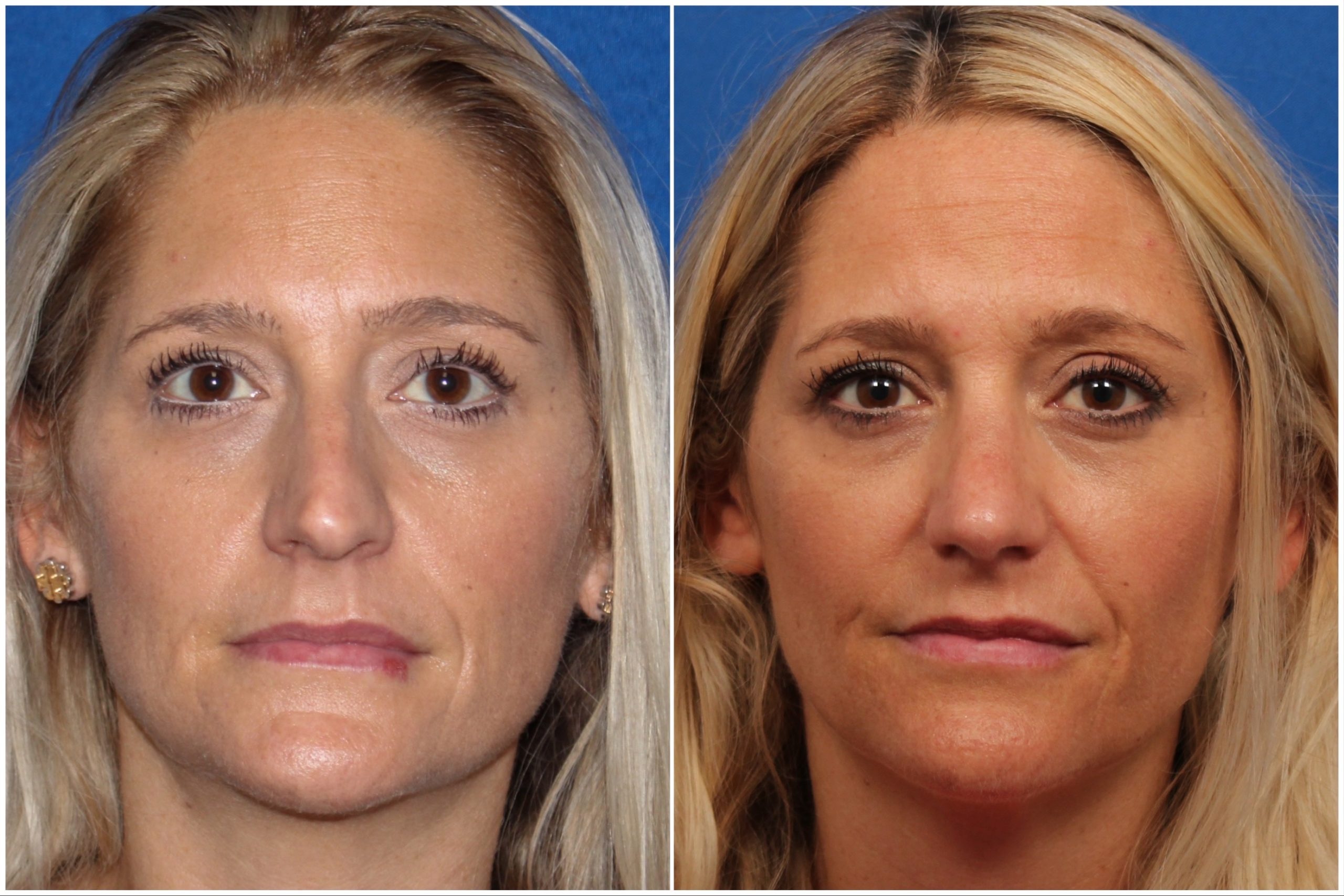 Female Rhinoplasty