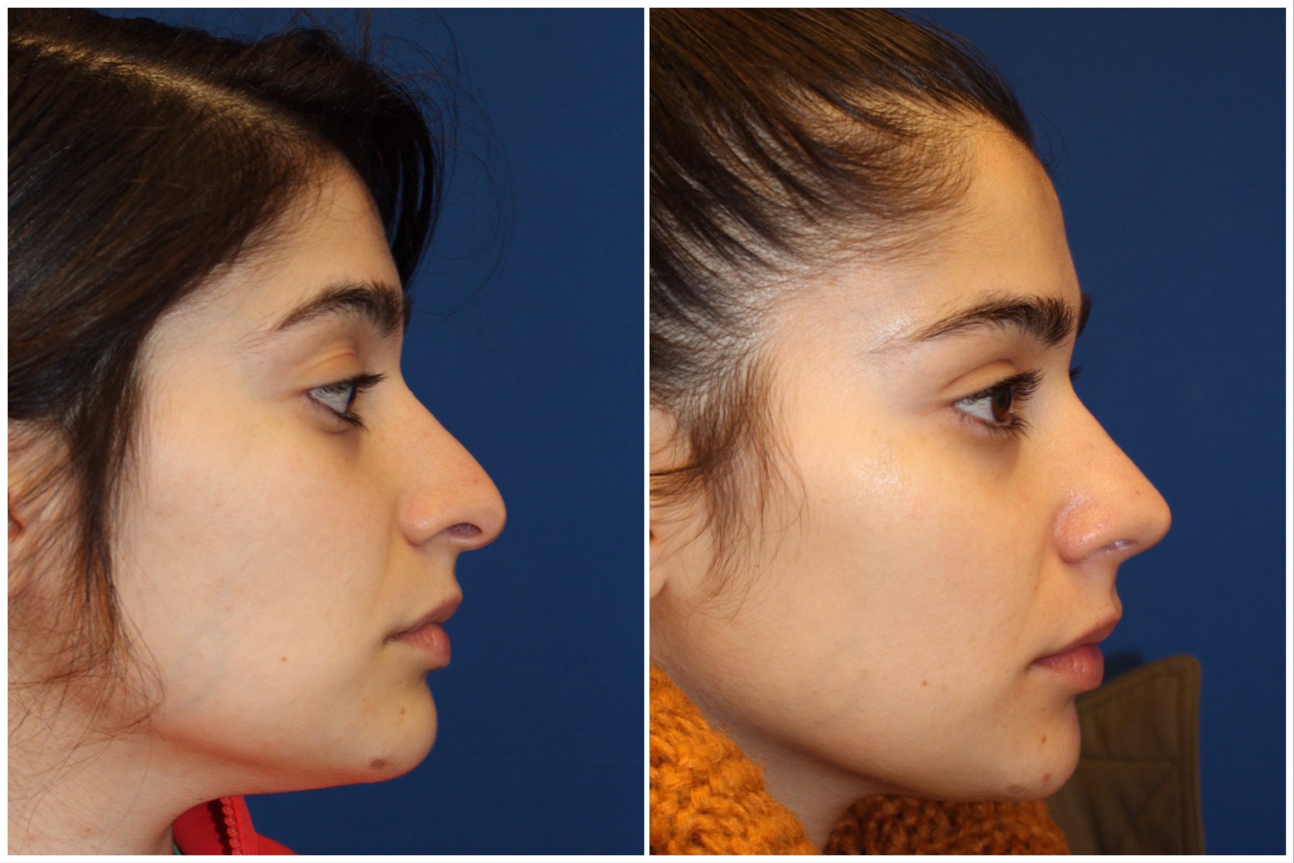 Female Rhinoplasty