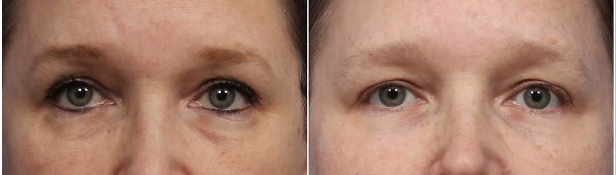 Fractional Plasma Therapy Before & After