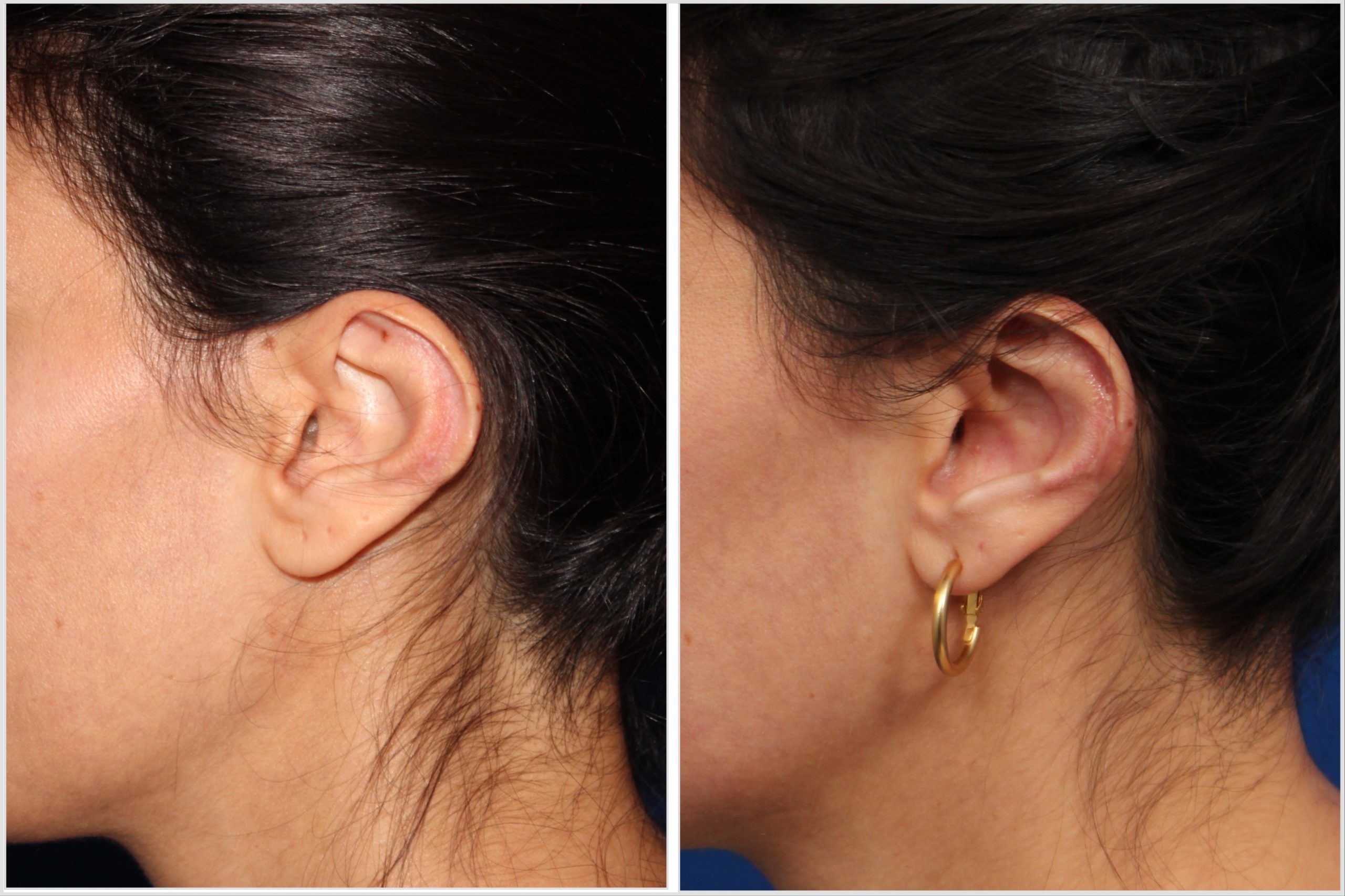 Cosmetic ear surgery near me deals