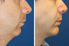 Male Chin Implant