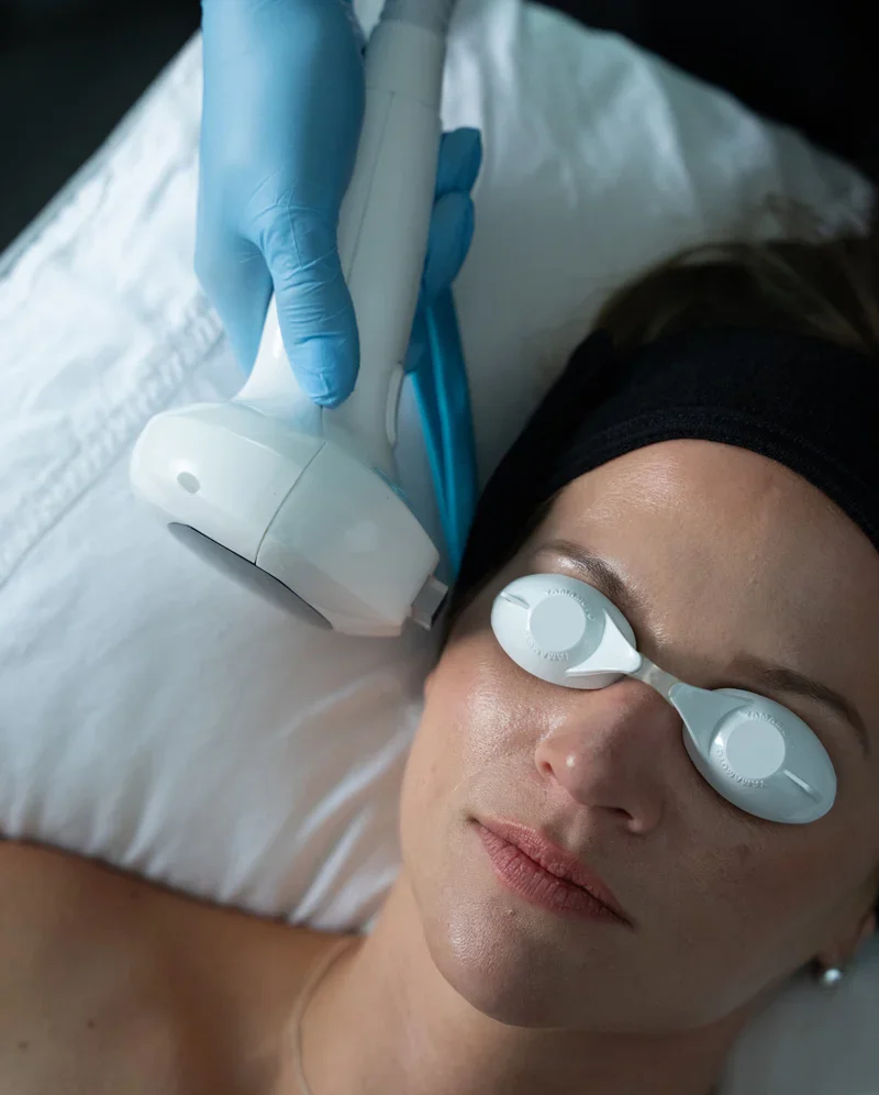 A close-up of a patient lying down for an IPL (Intense Pulsed Light) treatment. The patient, a woman wearing protective white eye shields and a black headband, has a professional's hand, wearing a blue glove, applying a white handheld device to her temple. - Latelier IPL in Troy, MI