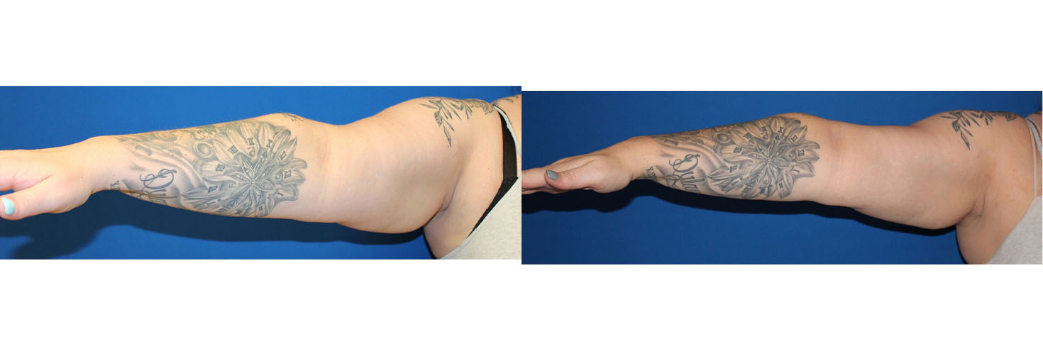 4504-nsskintight-p01-3