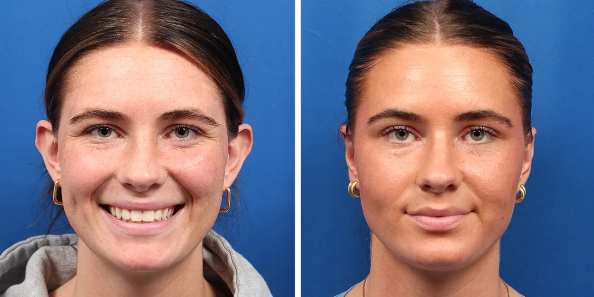 otoplasty_pattien-4_01