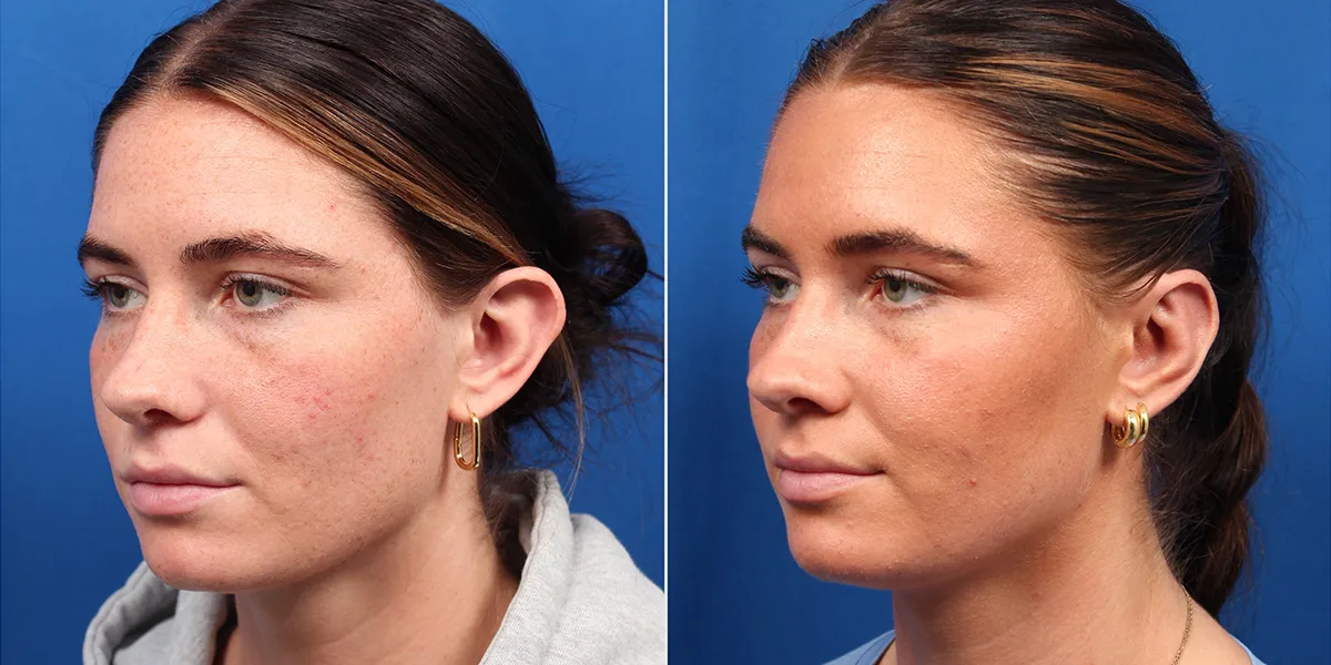 otoplasty_pattien-4_02