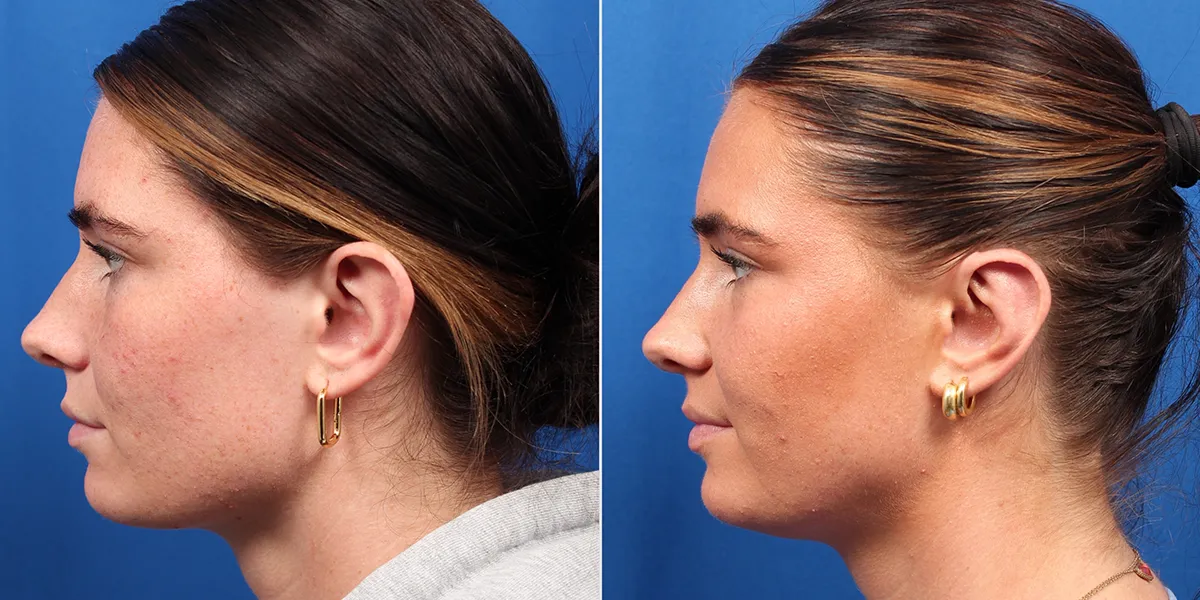 otoplasty_pattien-4_03