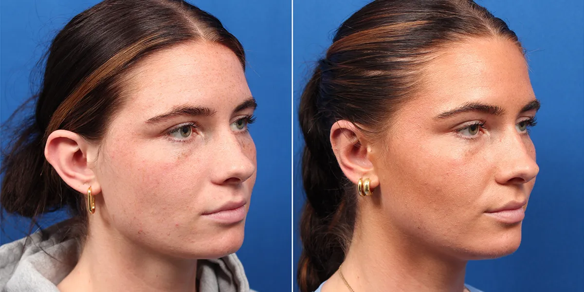 otoplasty_pattien-4_04