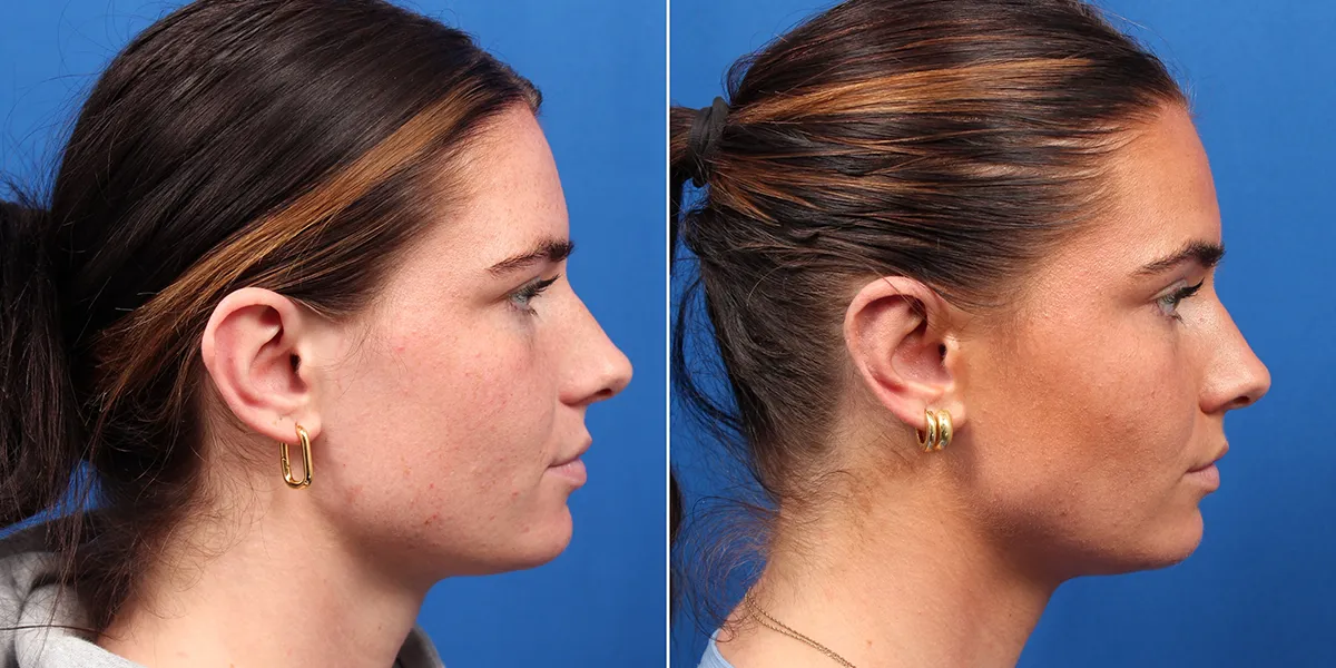 otoplasty_pattien-4_05