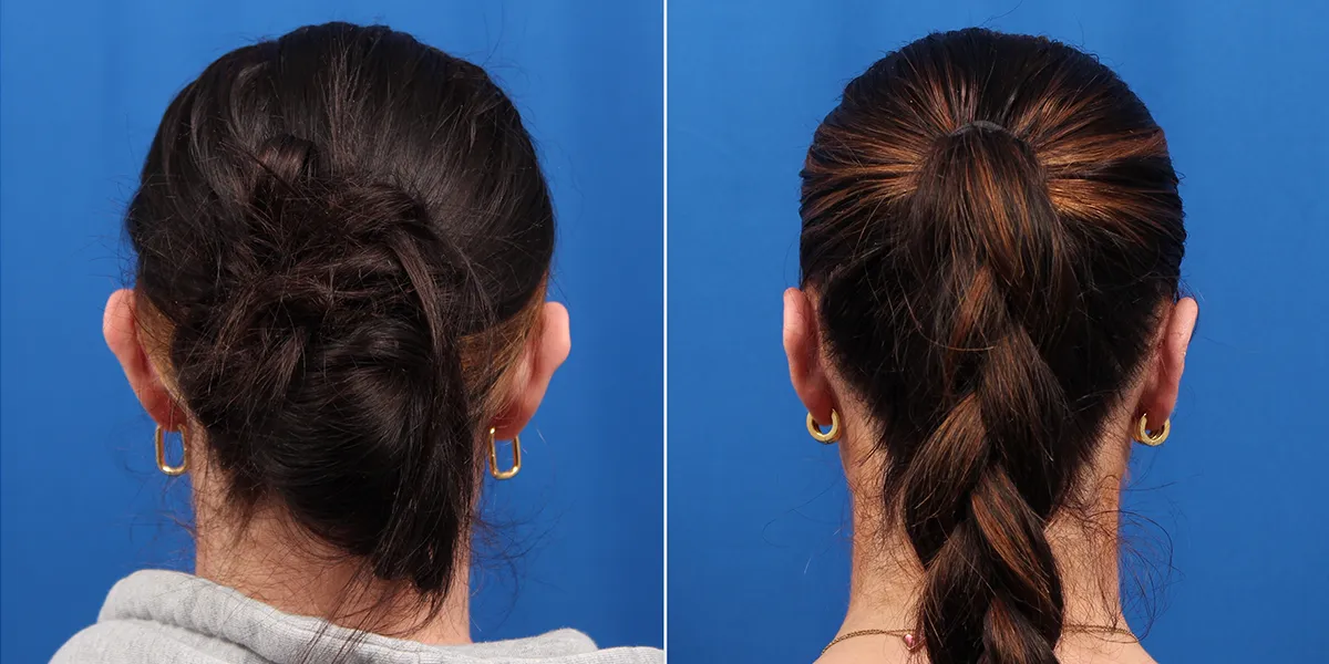 otoplasty_pattien-4_06