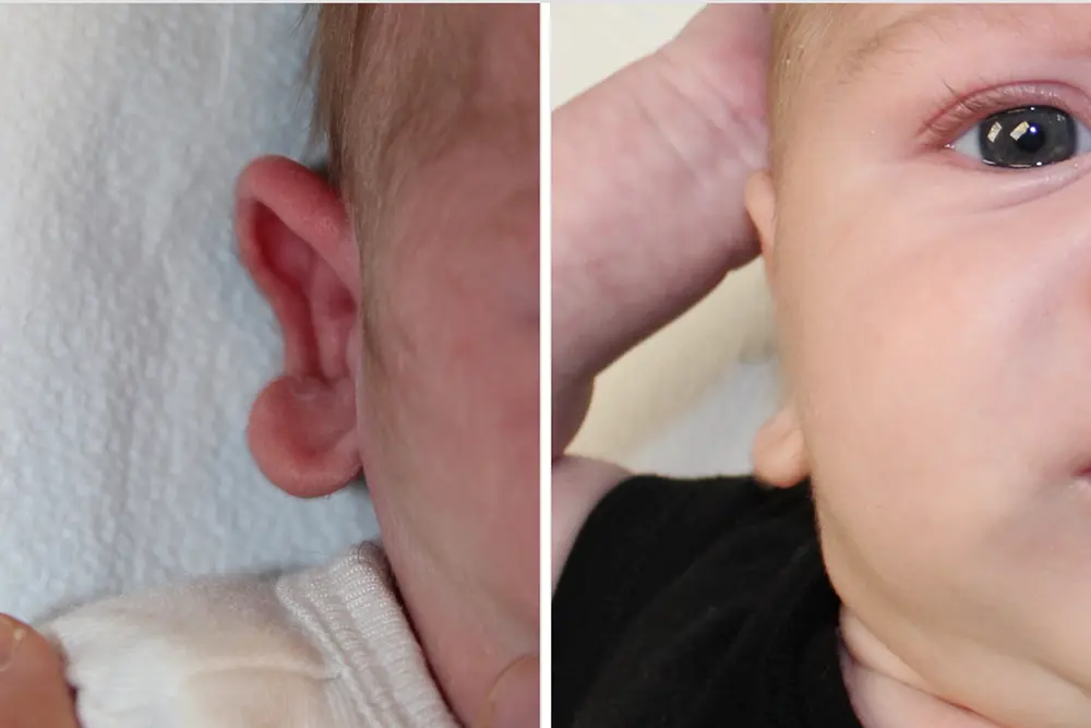 p30_Infant Ear Molding-1