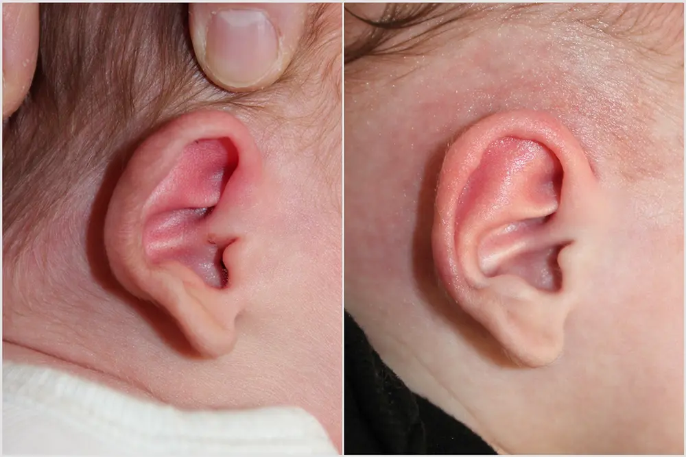 p30_Infant Ear Molding-2