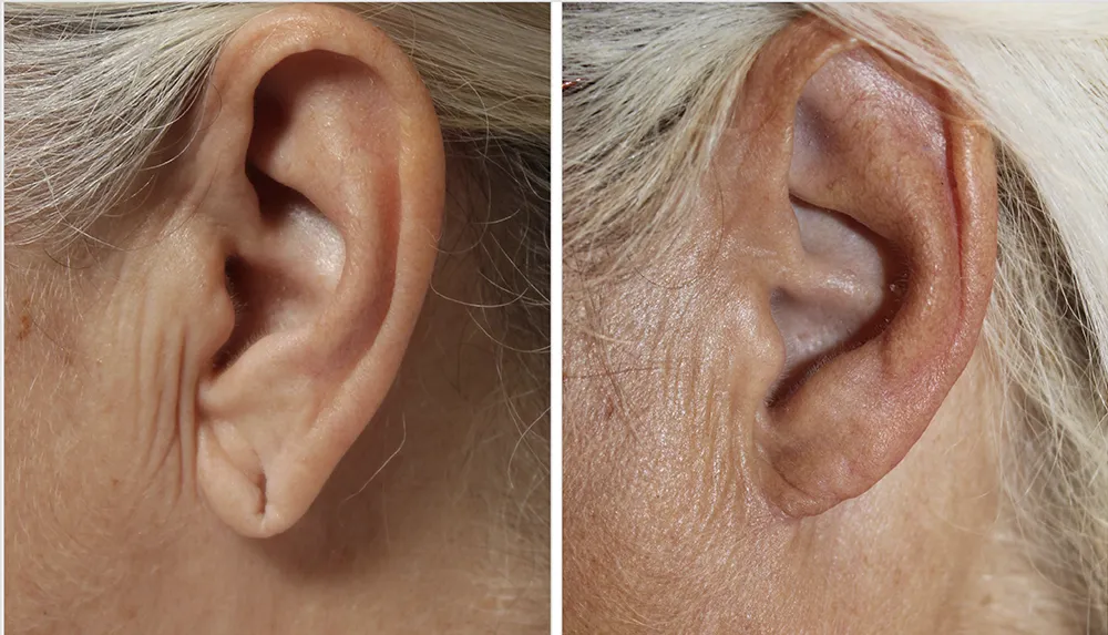patient2-earlobe_01