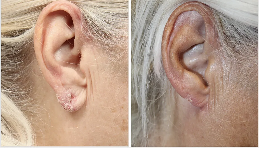 patient2-earlobe_02