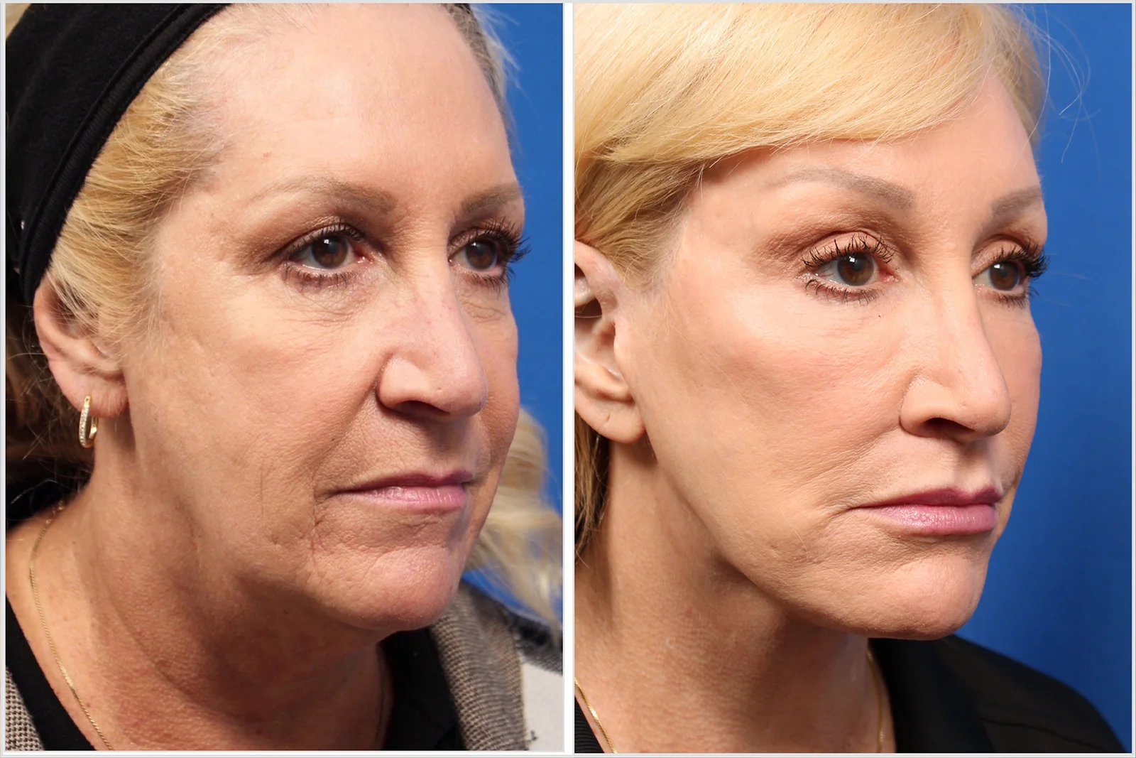 pt3_browlift_01