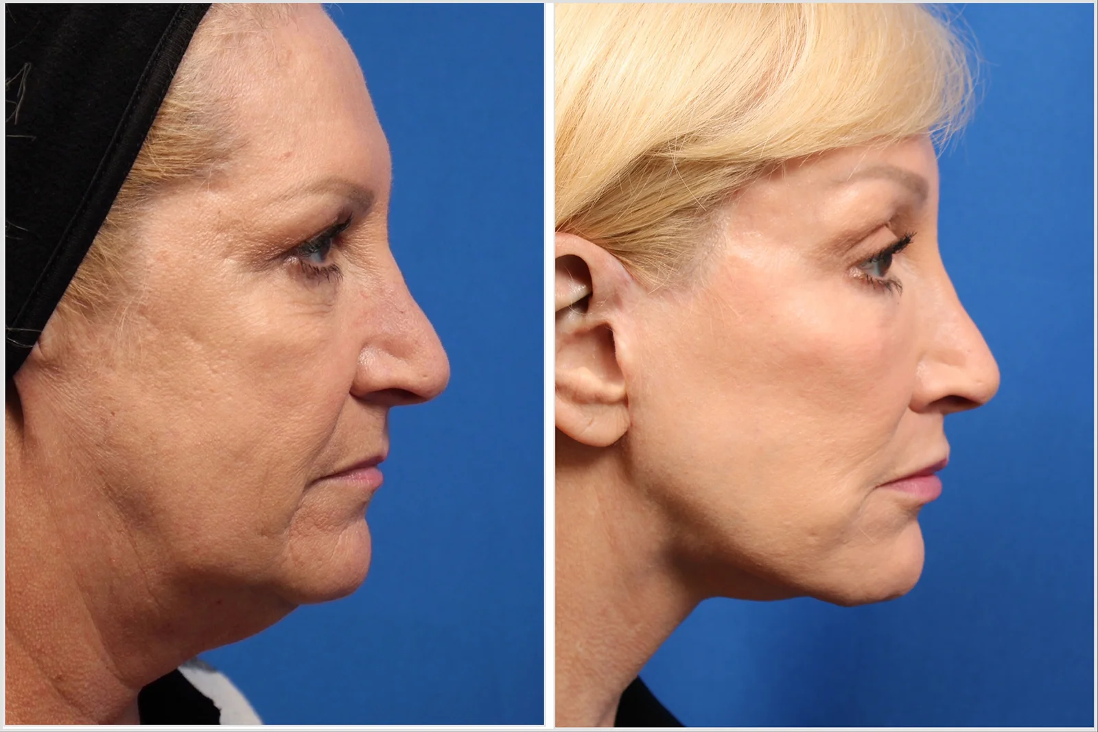 pt3_browlift_02