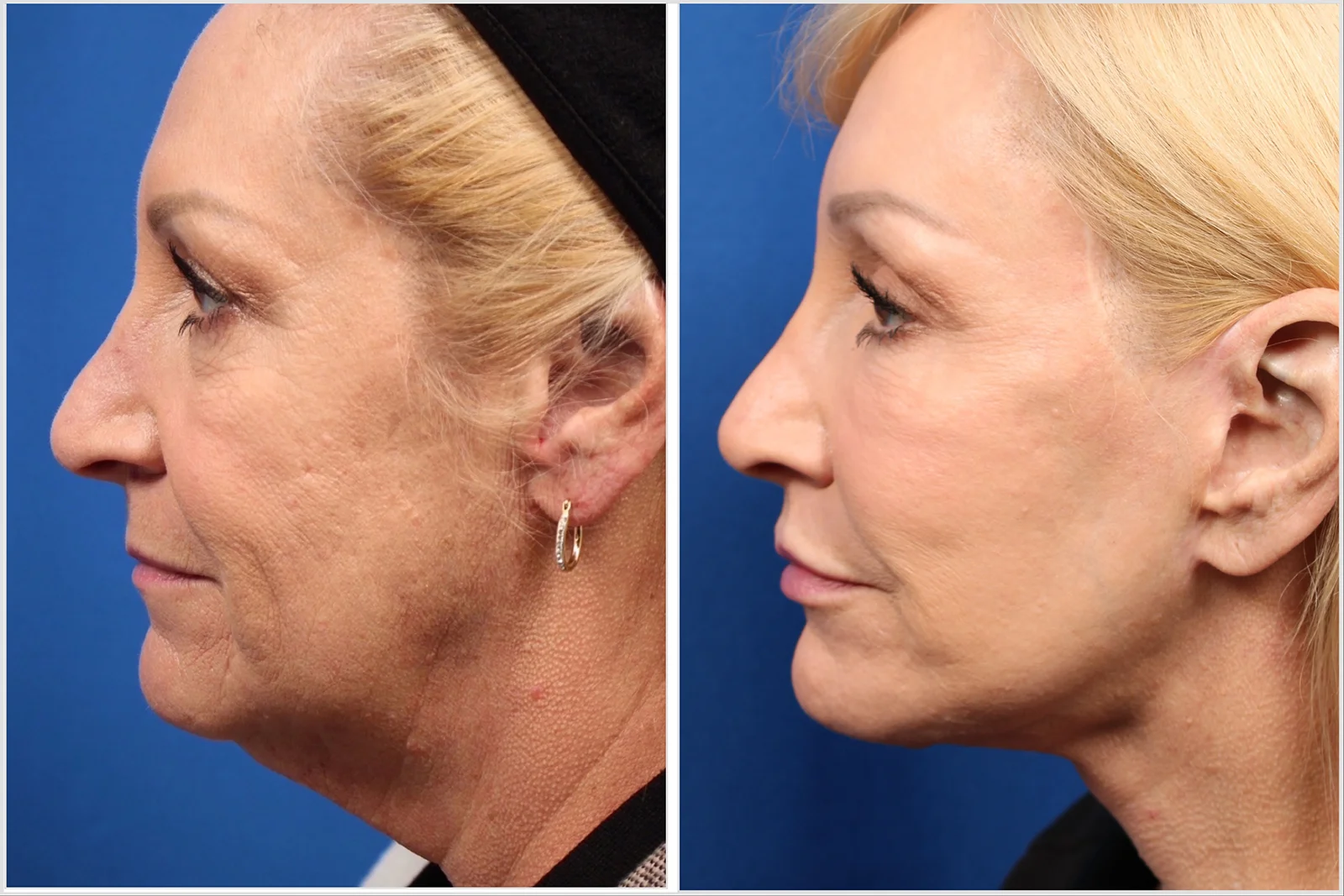 pt3_browlift_03