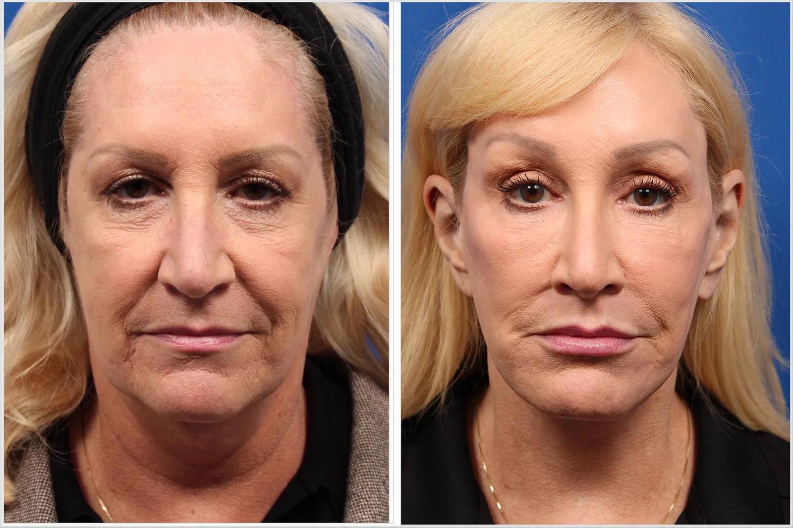 pt3_browlift_04