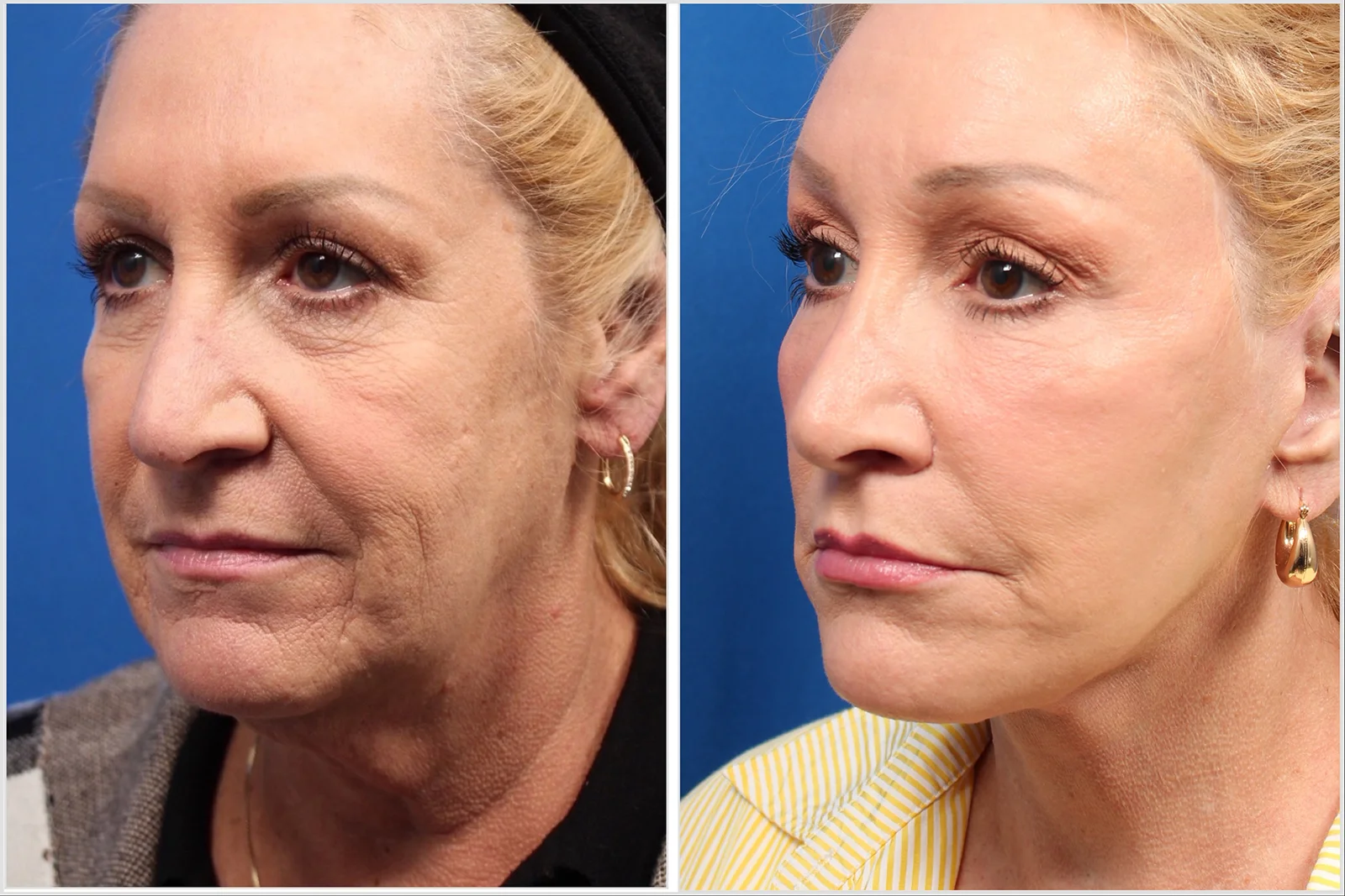 pt3_browlift_05